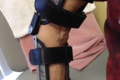 CustomElbowOrthosis1